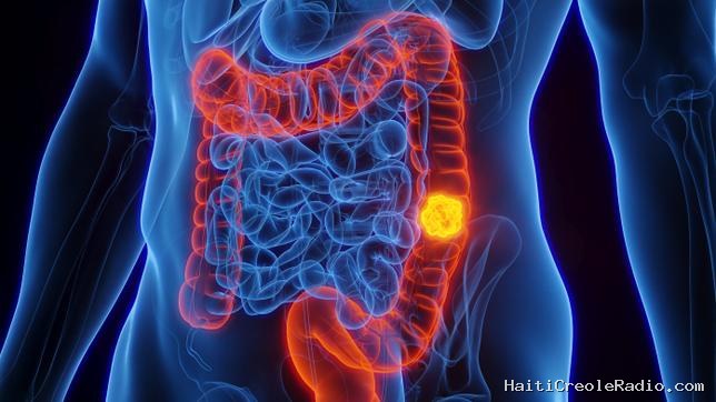 Les taux de cancer augmentent plus vite chez les personnes de moins de 50 ans